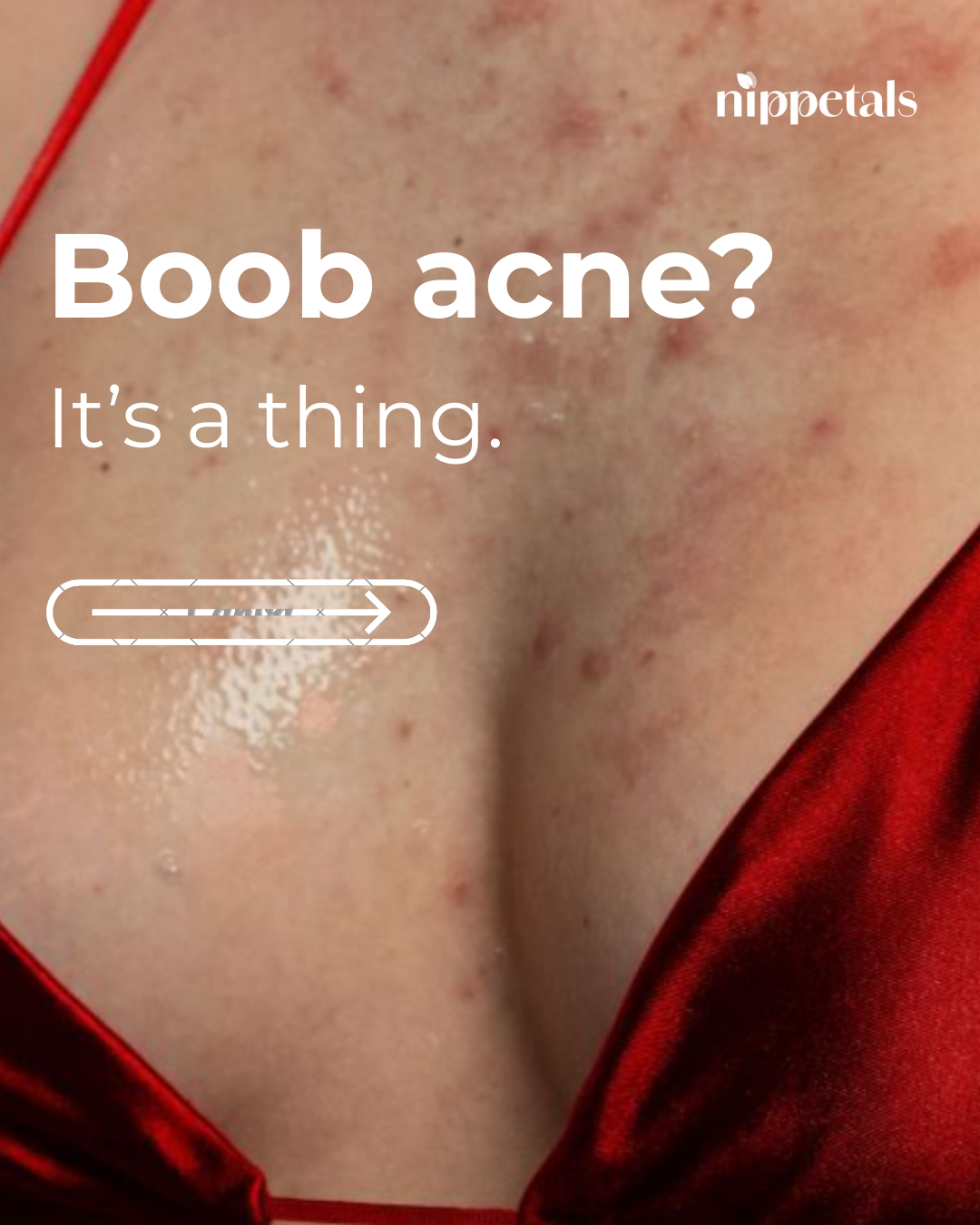 Boob Pimples: Causes, Care & Prevention